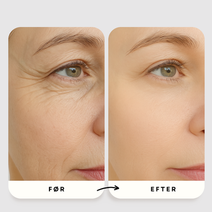 Mikro-Infusion Anti-Age Behandling™