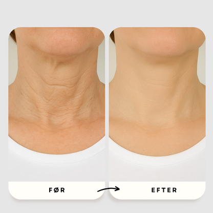 Mikro-Infusion Anti-Age Behandling™