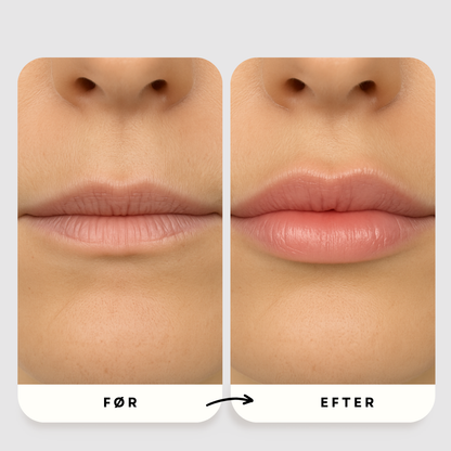 Mikro-Infusion Anti-Age Behandling™