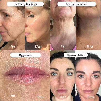 Mikro-Infusion Anti-Age Behandling™